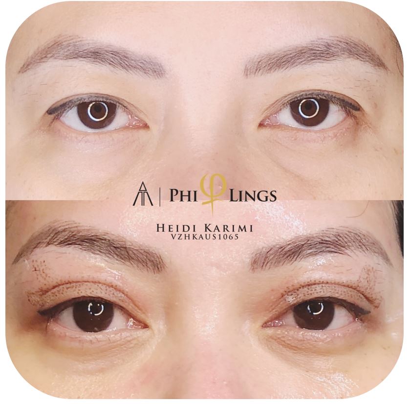 double eyelid surgery perth